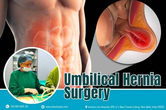 Umbilical hernia specialist